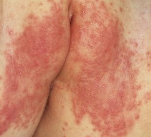Tratamento da dermatite na fralda em crianças pequenas