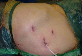 ginecologia cirurgia laparoscópica